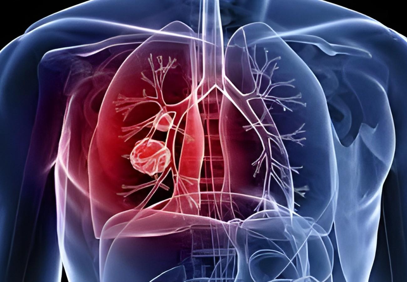Vereadores aprovam o Dia de Conscientização da Hipertensão Pulmonar em Araras