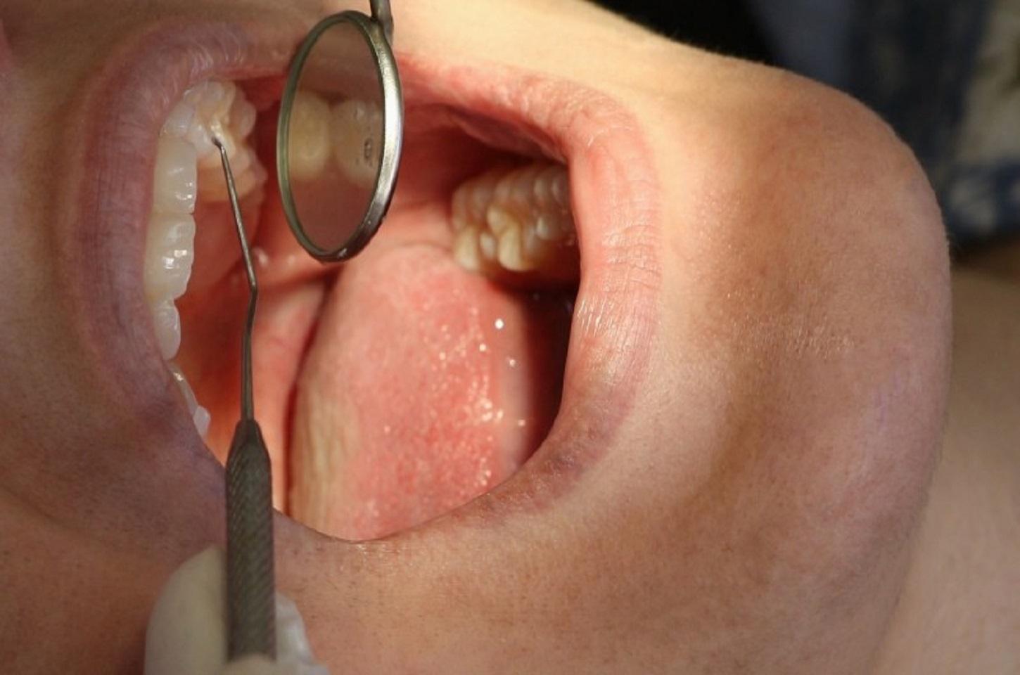 Saúde inicia atendimentos para confecção de próteses dentárias