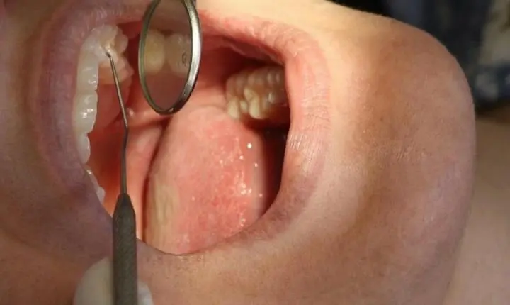 Saúde inicia atendimentos para confecção de próteses dentárias